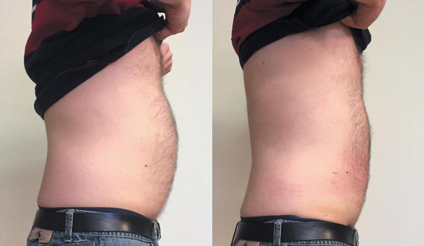 belly before - after